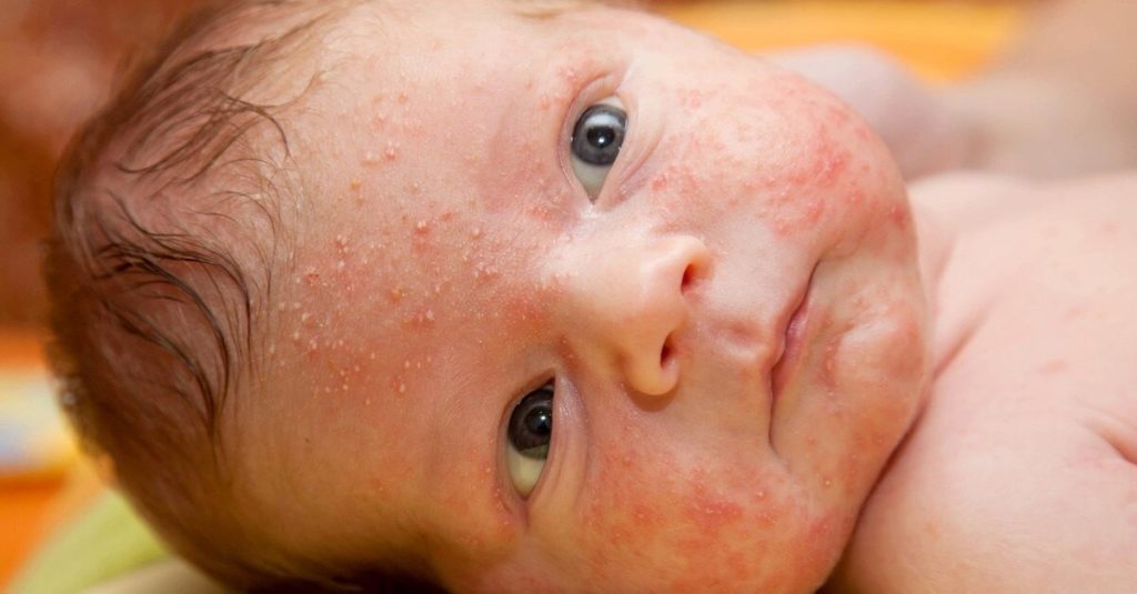 BABY ACNE